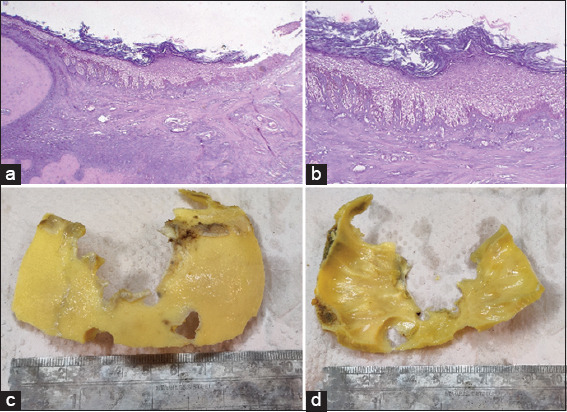 Epidermoid Tumor Resection — Figure 4