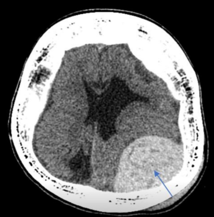 Epidural Hematoma Evacuation — Figure 1