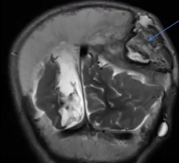 Epidural Hematoma Evacuation — Figure 2