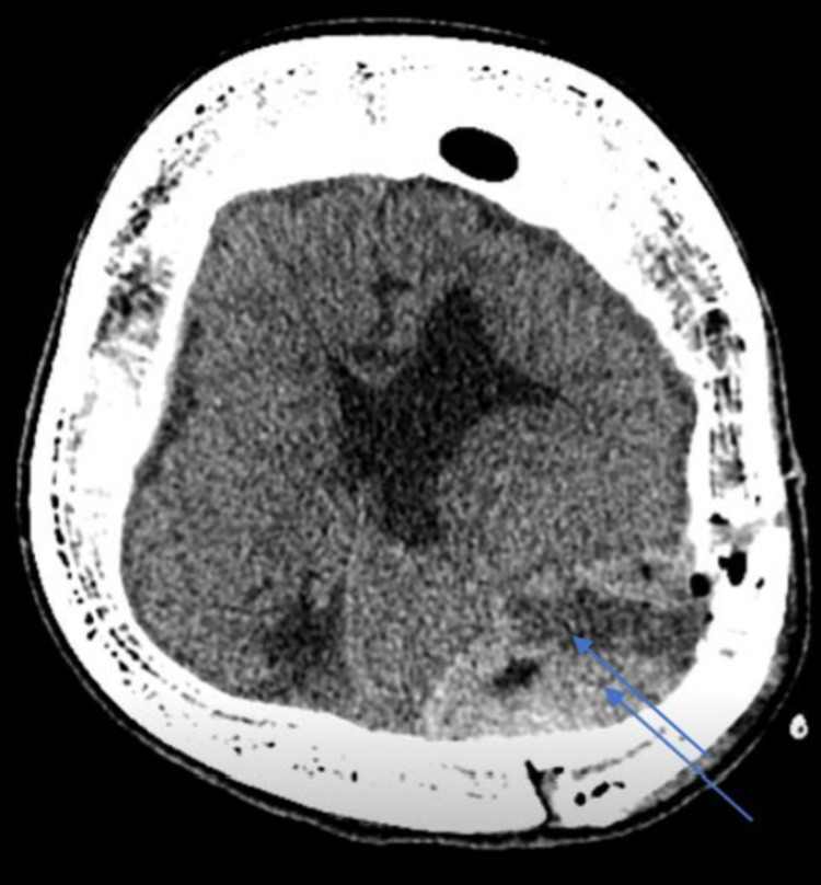 Epidural Hematoma Evacuation — Figure 3