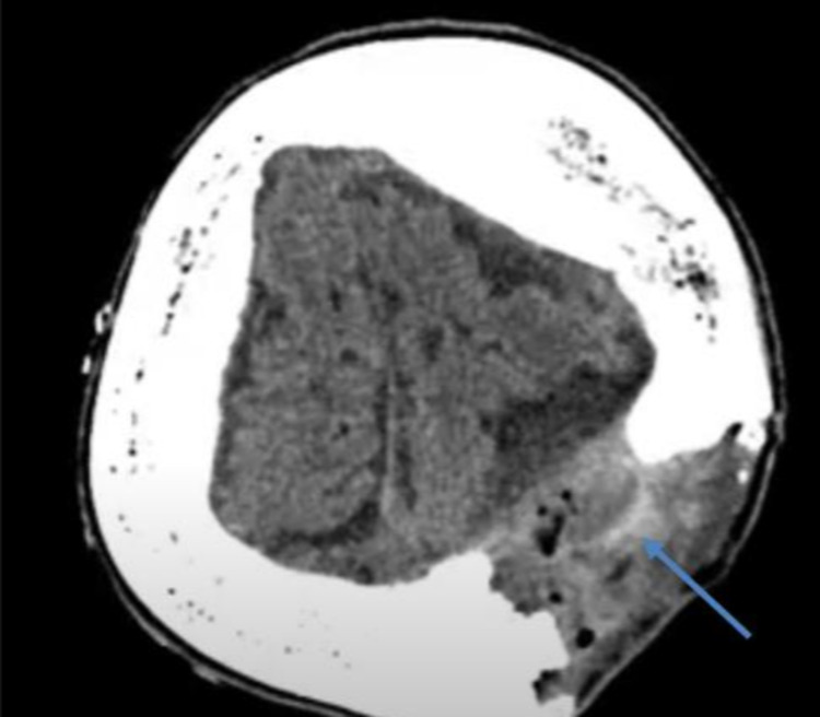 Epidural Hematoma Evacuation — Figure 4