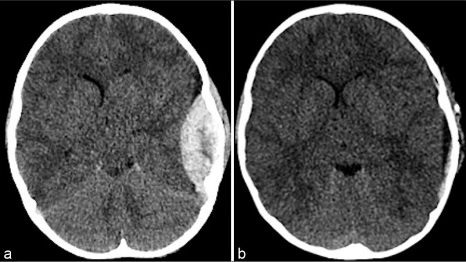 Epidural Hematoma Evacuation — Figure 1: