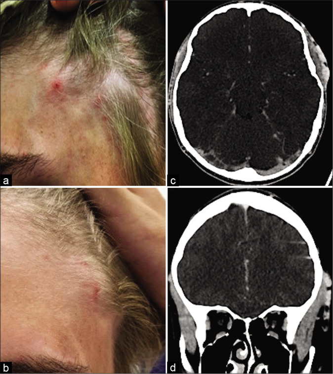 Epidural Hematoma Evacuation — Figure 2: