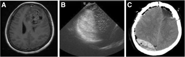 Epidural Hematoma Evacuation — Figure 1