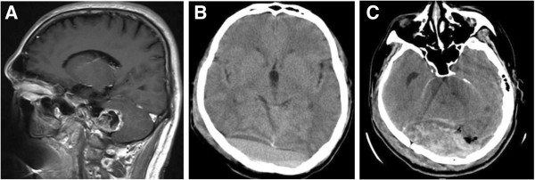 Epidural Hematoma Evacuation — Figure 2