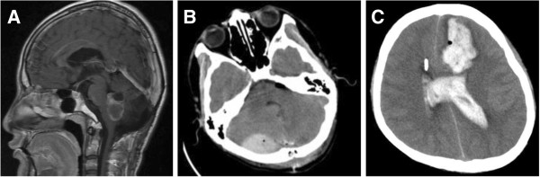 Epidural Hematoma Evacuation — Figure 3