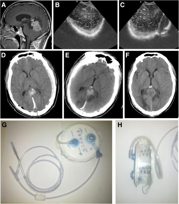 Epidural Hematoma Evacuation — Figure 4
