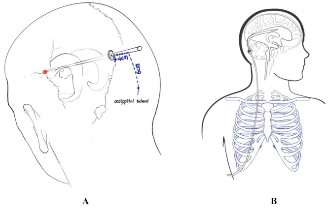 External Ventricular Drain Placement — Fig. 1