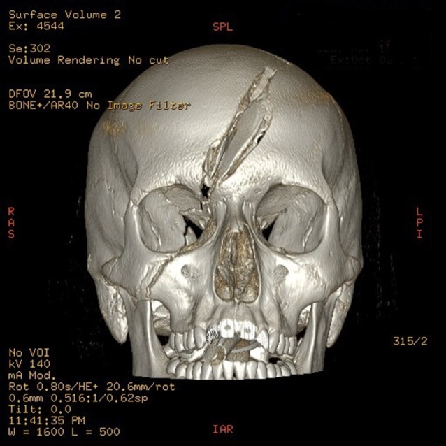 External Ventricular Drain Placement — Figure 1: