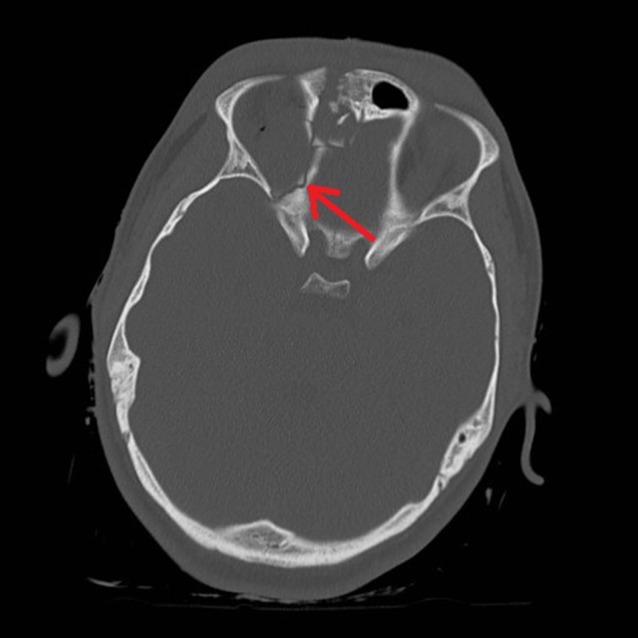 External Ventricular Drain Placement — Figure 2:
