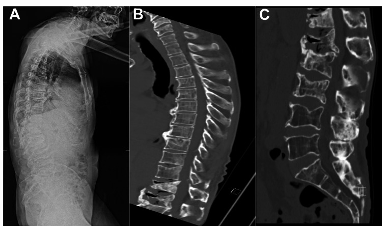External Ventricular Drain Placement — Figure 1