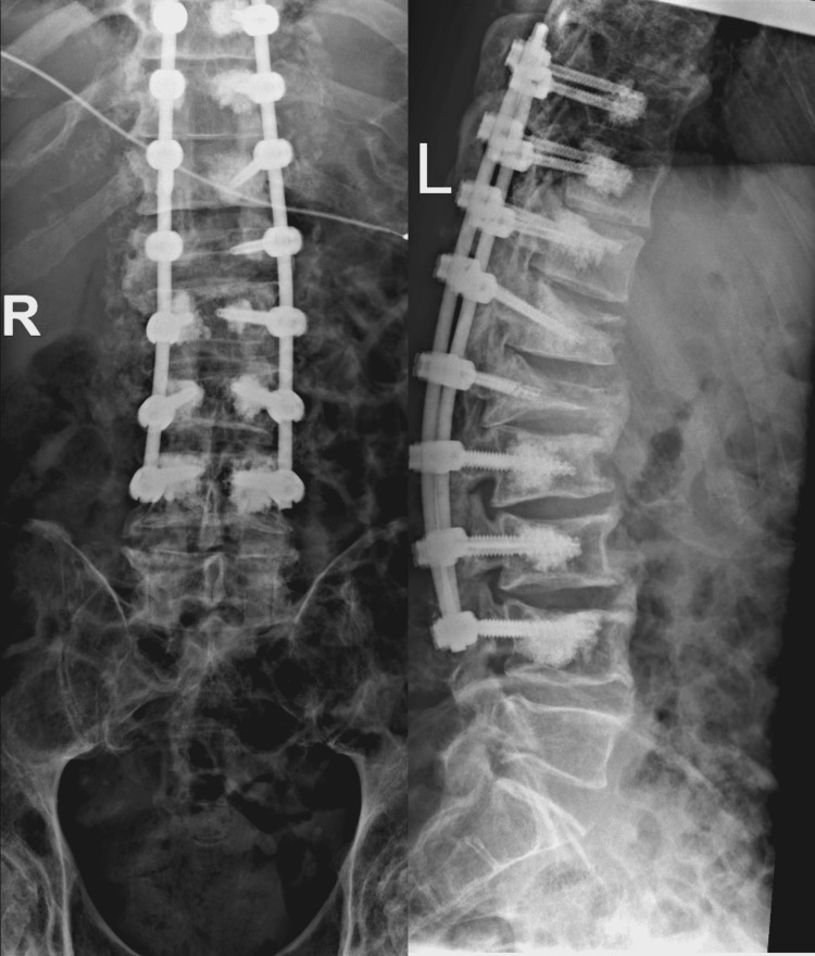 External Ventricular Drain Placement — Figure 3