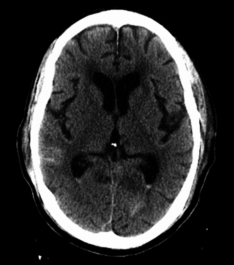 External Ventricular Drain Placement — Figure 4