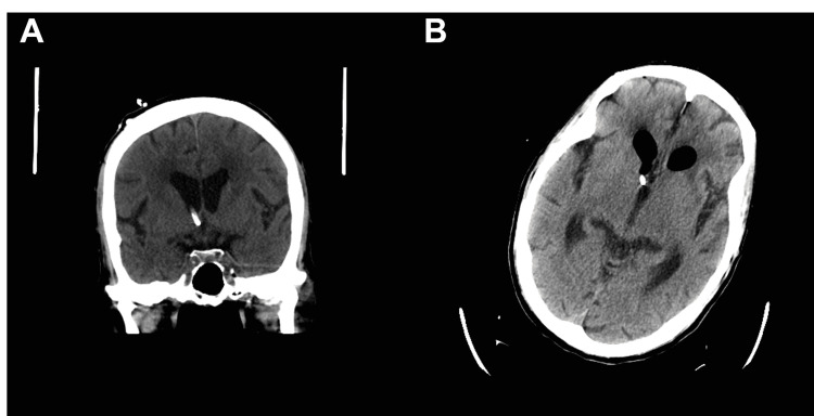 External Ventricular Drain Placement — Figure 5