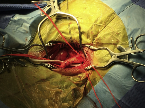 External Ventricular Drain Placement — Fig 1