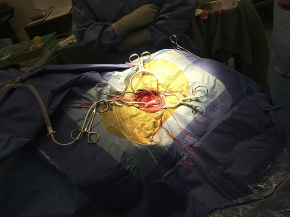 External Ventricular Drain Placement — Fig 2