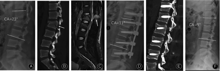 Flexion-Distraction Injury Fixation — Fig. 4