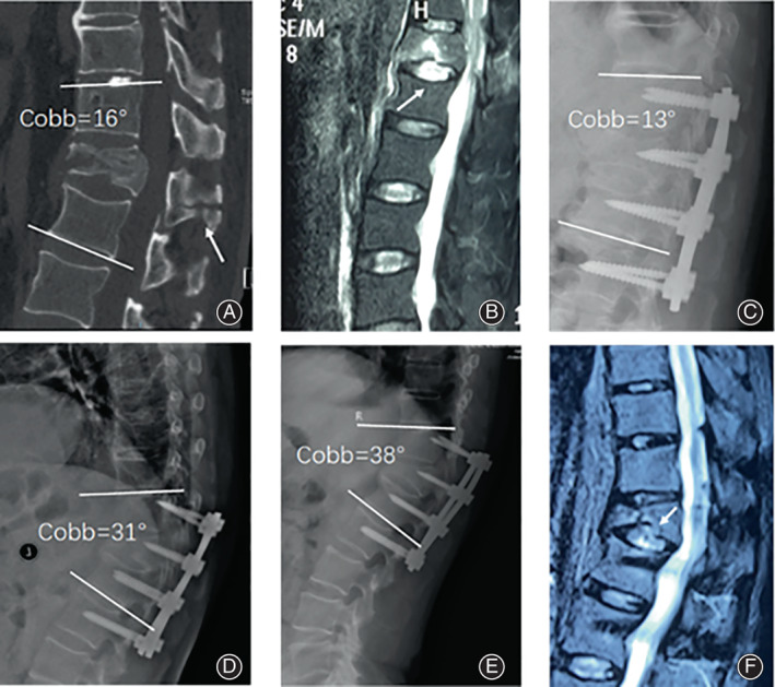 Flexion-Distraction Injury Fixation — Fig. 5