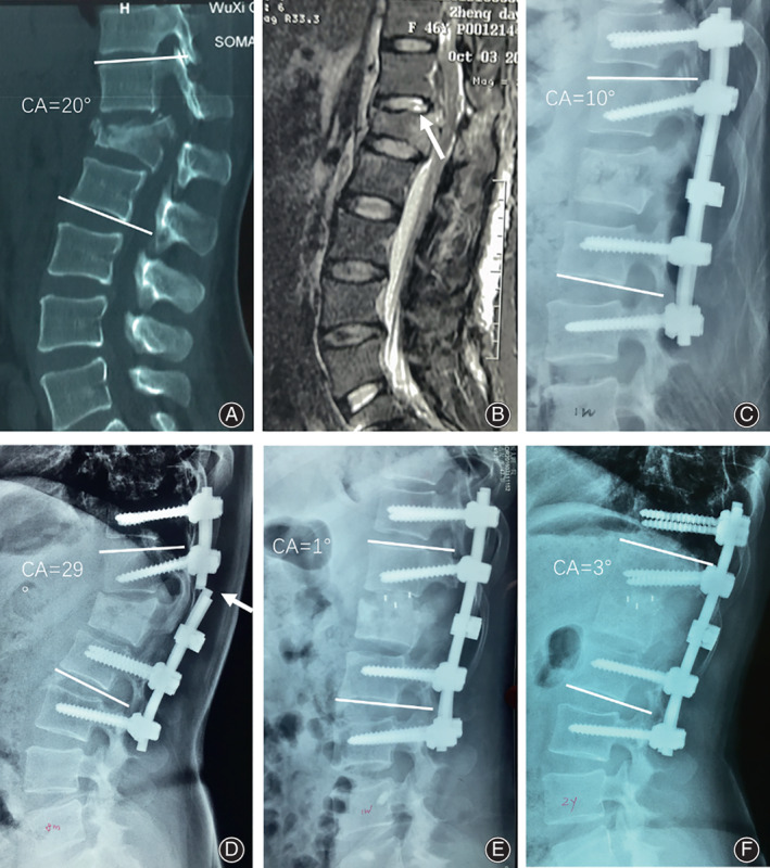 Flexion-Distraction Injury Fixation — Fig. 6