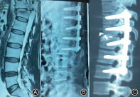 Flexion-Distraction Injury Fixation — Figure 4