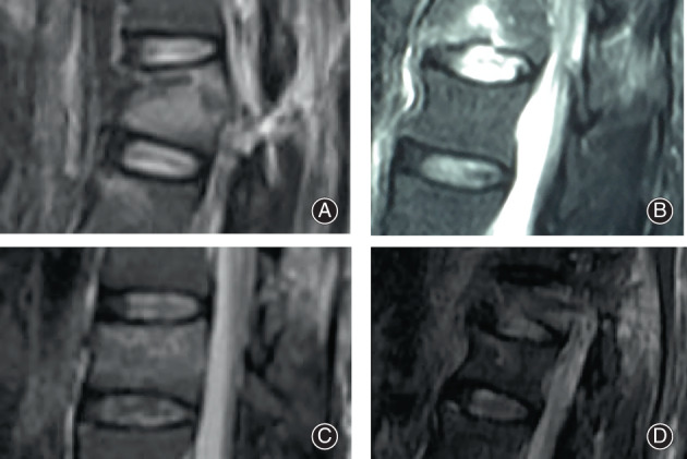 Flexion-Distraction Injury Fixation — Fig. 1
