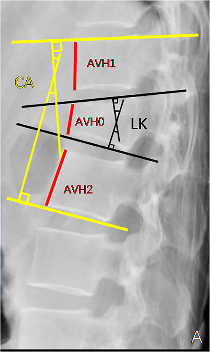 Flexion-Distraction Injury Fixation — Fig. 2