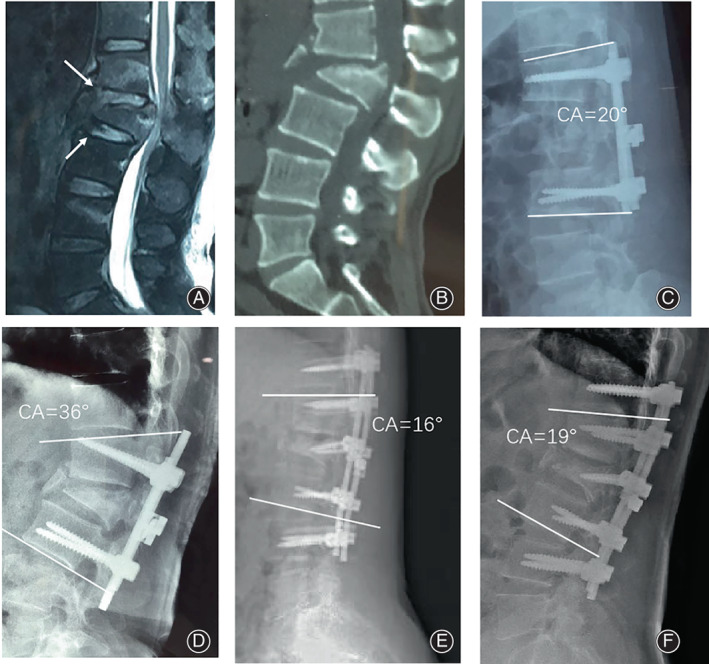 Flexion-Distraction Injury Fixation — Fig. 7