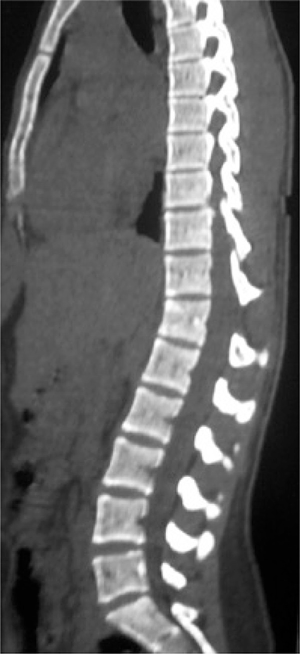 Flexion-Distraction Injury Fixation — Figure 1
