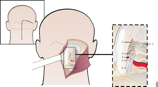 Foramen Magnum Meningioma Far Lateral Approach — Fig. 1