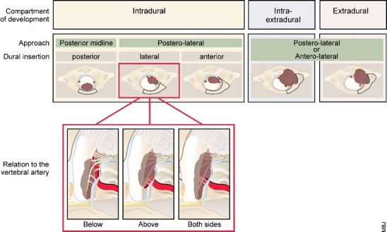 Foramen Magnum Meningioma Far Lateral Approach — Fig. 2