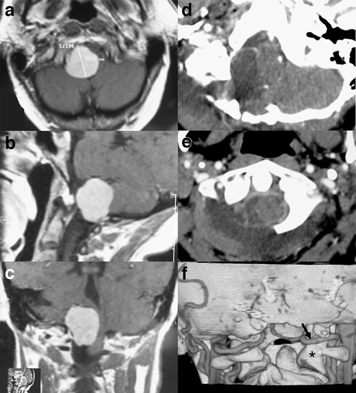 Foramen Magnum Meningioma Far Lateral Approach — Fig. 3