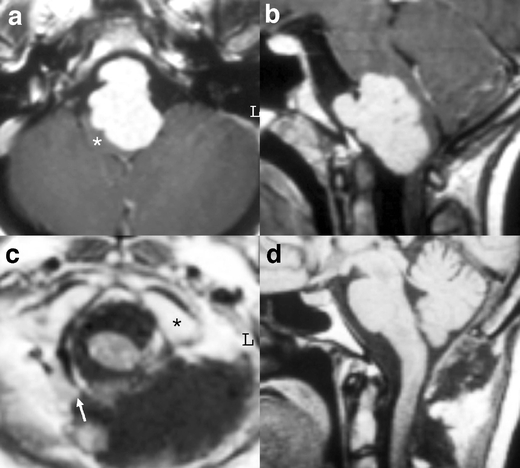 Foramen Magnum Meningioma Far Lateral Approach — Fig. 4