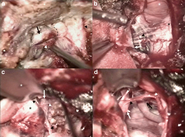 Foramen Magnum Meningioma Far Lateral Approach — Fig. 5