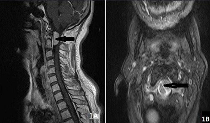 Foramen Magnum Meningioma Far Lateral Approach — Figure 1