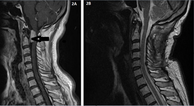 Foramen Magnum Meningioma Far Lateral Approach — Figure 2