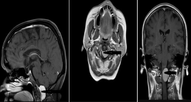 Foramen Magnum Meningioma Far Lateral Approach — Figure 3