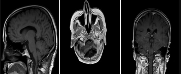 Foramen Magnum Meningioma Far Lateral Approach — Figure 4
