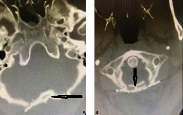 Foramen Magnum Meningioma Far Lateral Approach — Figure 5