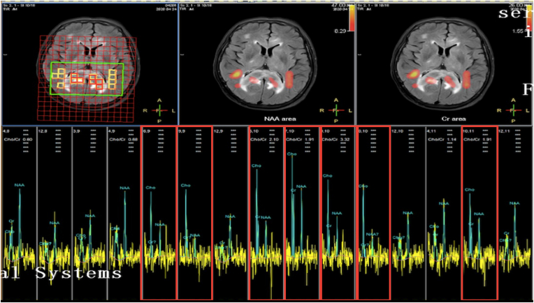 Frame-Based Stereotactic Brain Biopsy — Figure 2