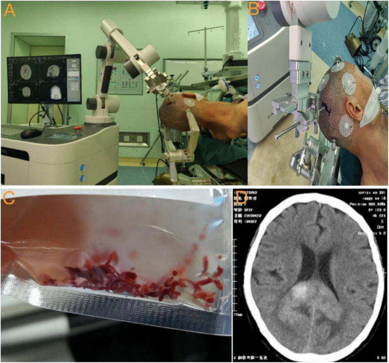 Frame-Based Stereotactic Brain Biopsy — Figure 3