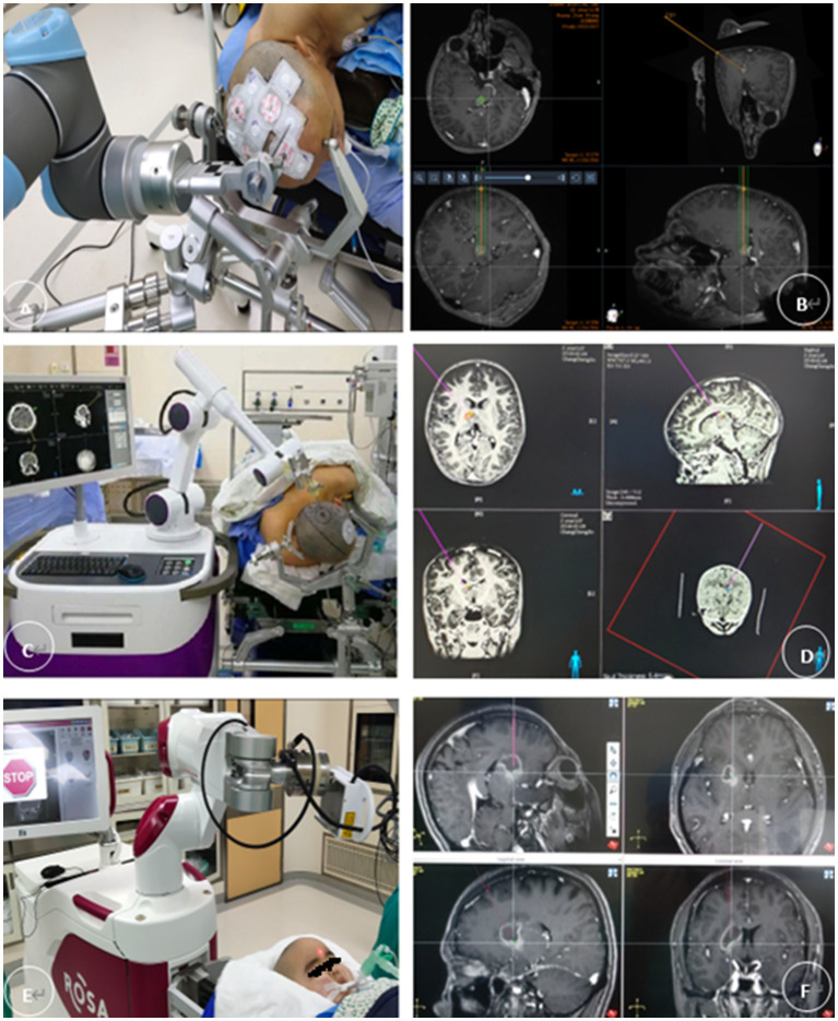 Frame-Based Stereotactic Brain Biopsy — Figure 2