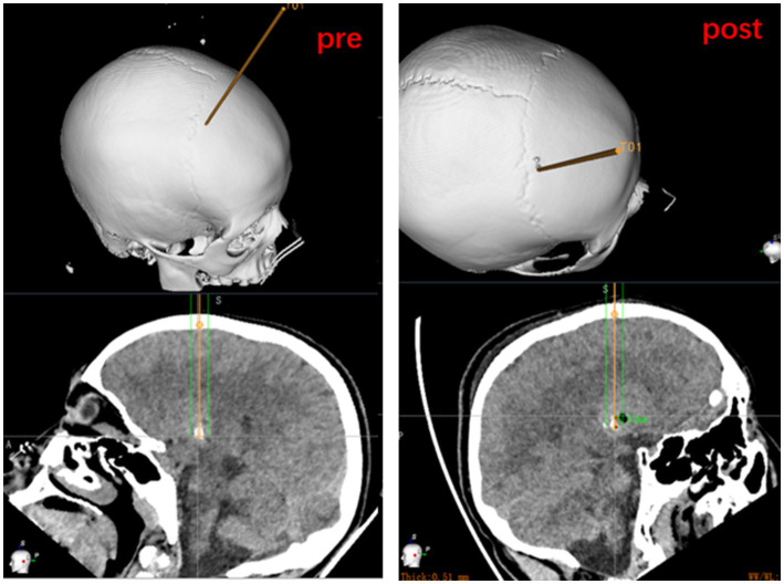 Frame-Based Stereotactic Brain Biopsy — Figure 3