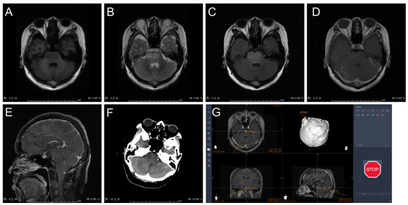 Frameless Stereotactic Brain Biopsy — Figure 2