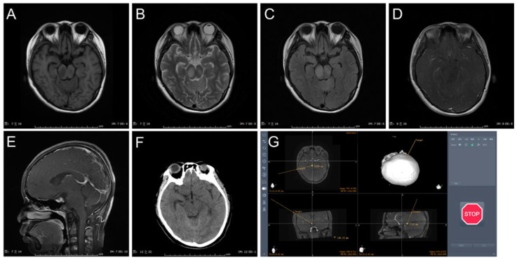 Frameless Stereotactic Brain Biopsy — Figure 3