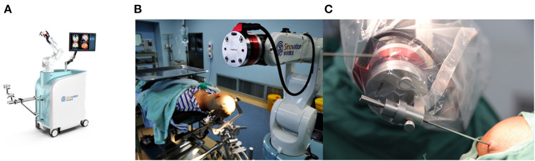Frameless Stereotactic Brain Biopsy — Figure 1