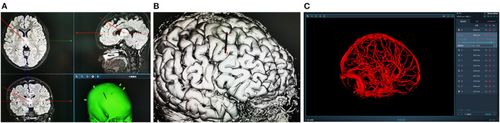Frameless Stereotactic Brain Biopsy — Figure 2