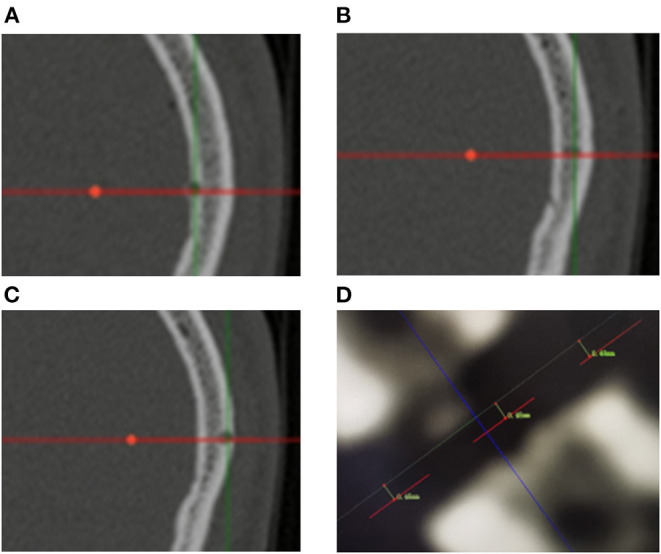 Frameless Stereotactic Brain Biopsy — Figure 3