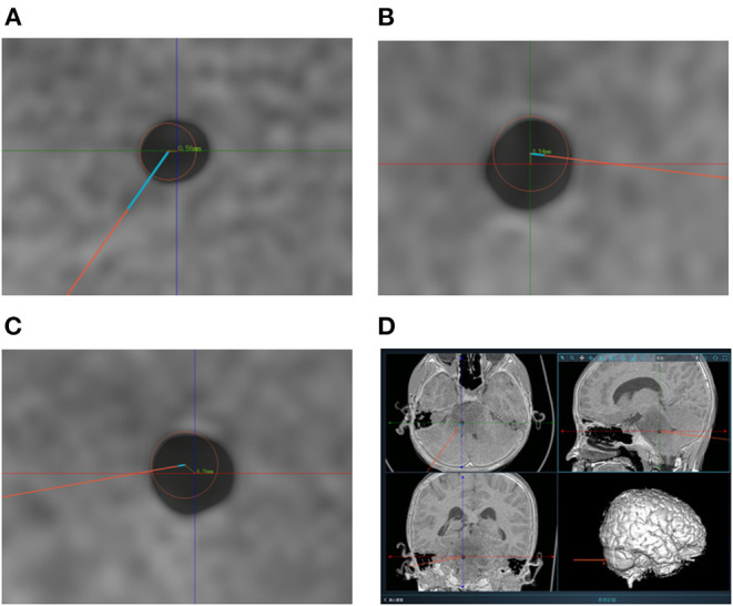 Frameless Stereotactic Brain Biopsy — Figure 4