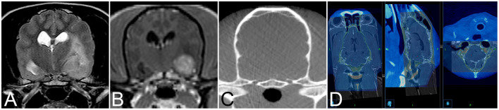 Frameless Stereotactic Brain Biopsy — Figure 2