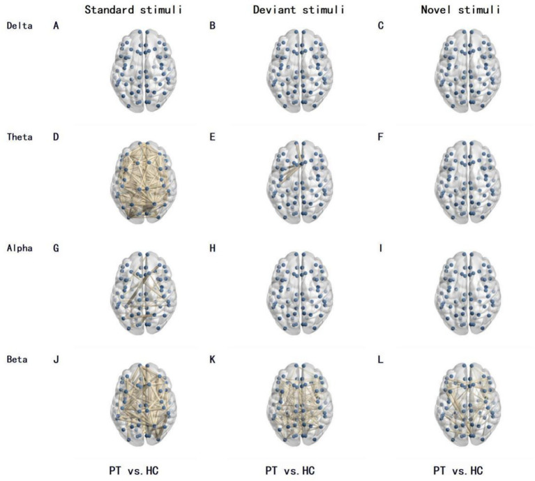 Insular Glioma Resection — Figure 1